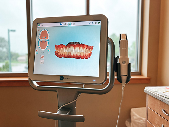 iTero 3D Scanning in Lansing & Okemos MI - Bains Orthodontics