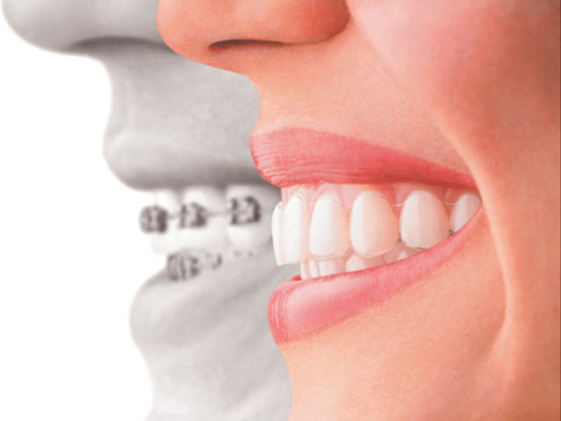 Invisalign for Adults in Lansing & Okemos MI - Bains Orthodontics